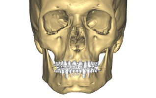 Chirurgie orthognathique sur mesure