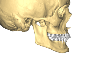 Chirurgie orthognathique sur mesure