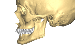 Chirurgie orthognathique sur mesure