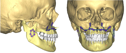 Chirurgie orthognathique sur mesure