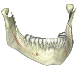 Chirurgie orthognathique sur mesure