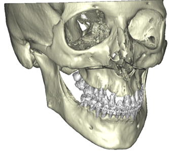 Chirurgie orthognathique sur mesure