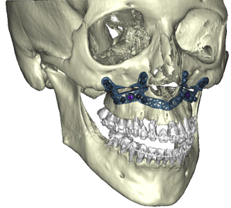 Chirurgie orthognathique sur mesure