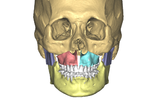 Chirurgie orthognathique sur mesure