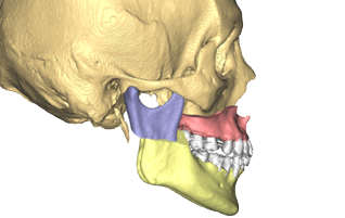 Chirurgie orthognathique sur mesure