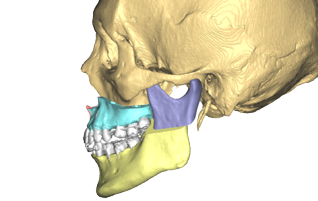 Chirurgie orthognathique sur mesure