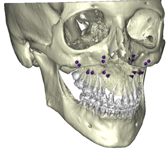 Chirurgie orthognathique sur mesure