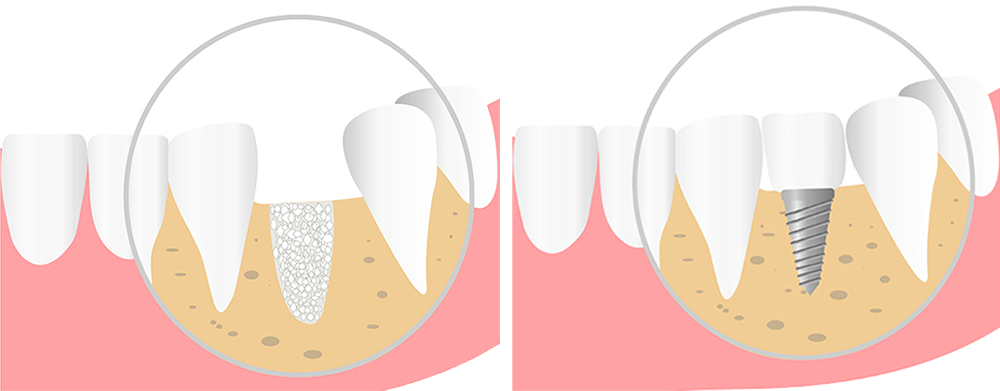 CMF - Preservation alveolaire