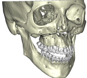 Chirurgie orthognathique sur mesure