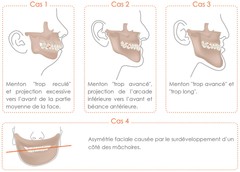 Chirurgie orthognatique Lyon Chirurgien maxillofacial Lyon