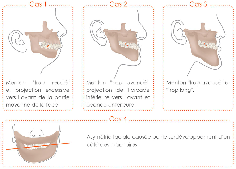 CMF - Schema chirurgie orthognathique